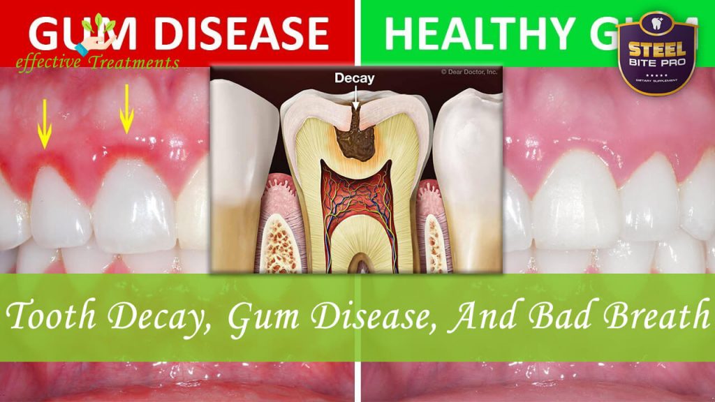 Tooth Decay Gum Disease Bad Breath