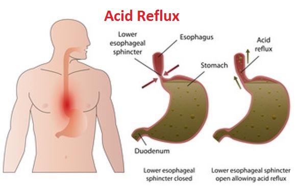 Acid Reflux Causes
