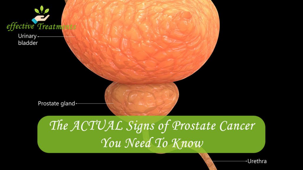 The ACTUAL Signs of Prostate Cancer You Need To Know
