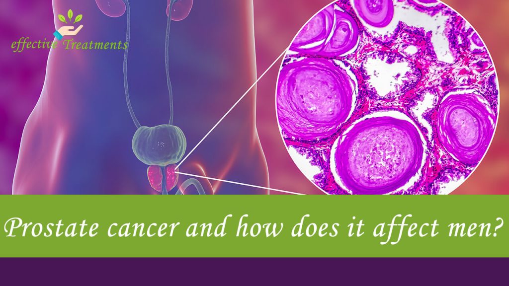 What is prostate cancer and how does it affect men