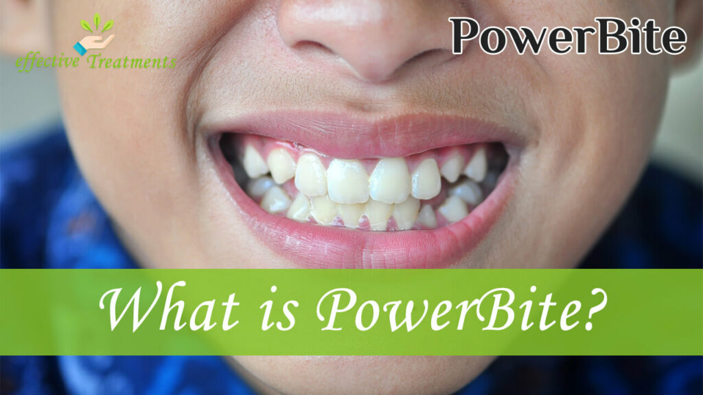 What is PowerBite